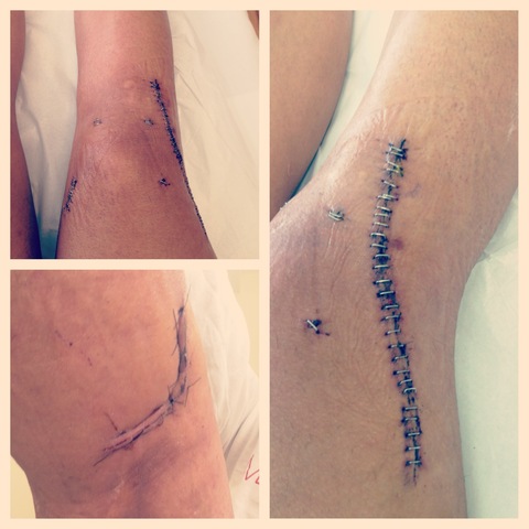 2 weeks post-op: follow-up with surgeon