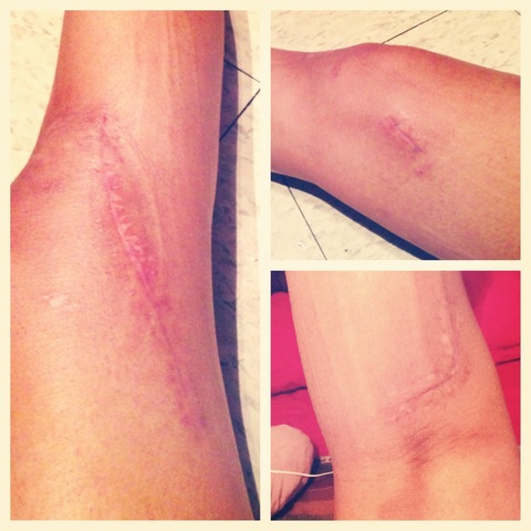 6 weeks post-op: Beginning of WBAT