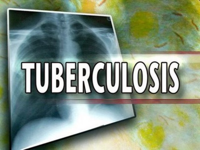 Tuberculosis