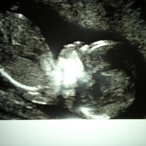 First ultrasound