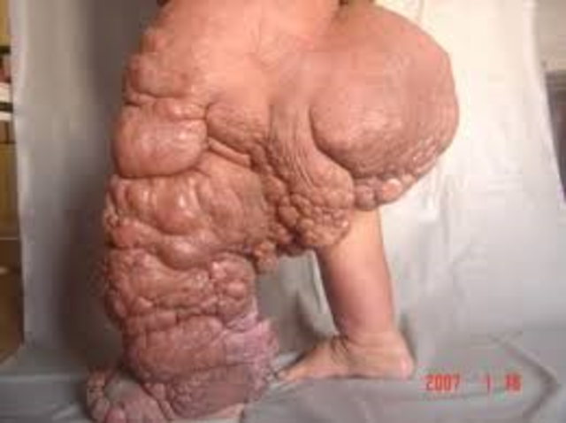 History of Elephantiasis