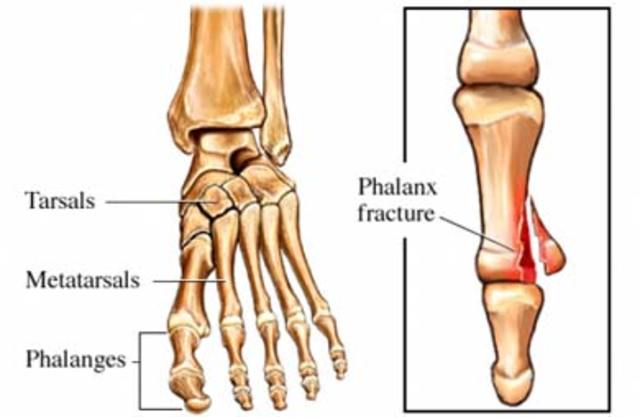 Fractura de un pie