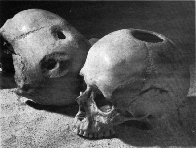 Las primeras trepanaciones