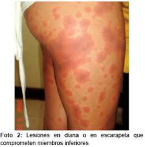 Se descubre la DIFTERIA