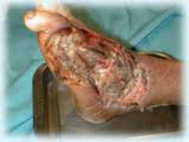 Se descubre el tétano