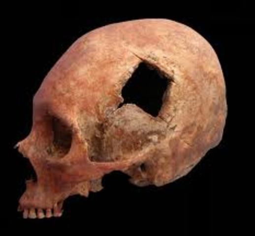 TREPANACION EN PUEBLOS NATIVOS