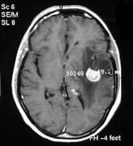 Brain tumour removed