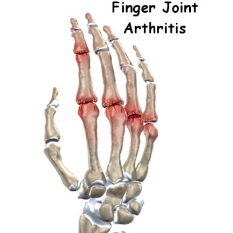 Develops Arthritis