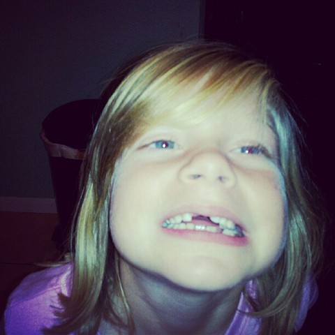 Lost my two front teeth