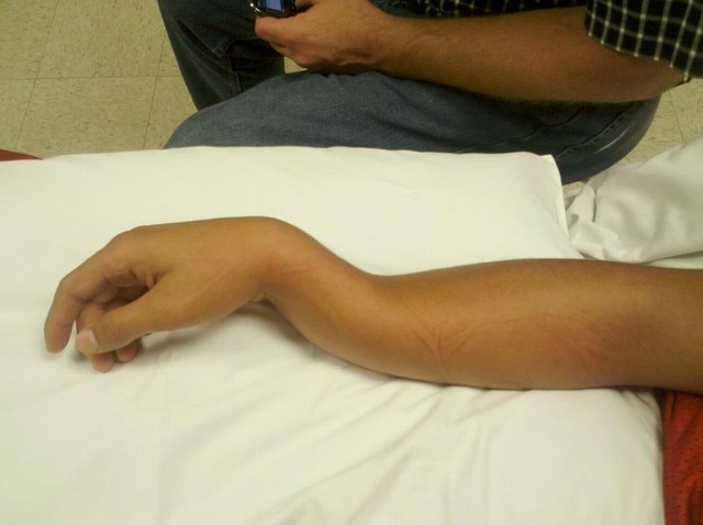 Broke arm in football