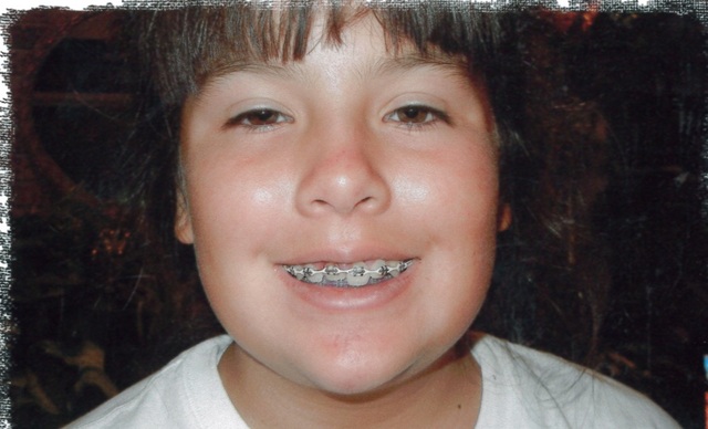 My tooth got pushed halfway up from an accident playing kickball.