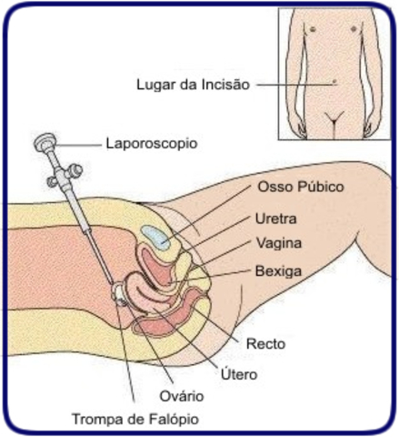 Celioscopia