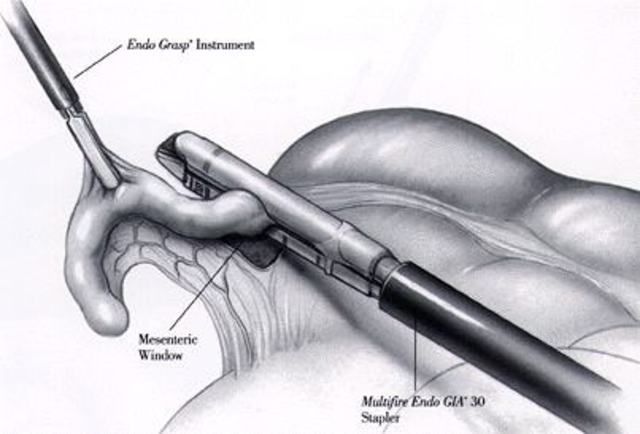 apendicectomìa laparoscòpica
