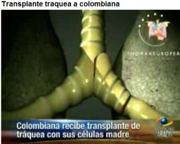 TRASPLANTE DE  CELULAS MADRE EN COLOMBIA