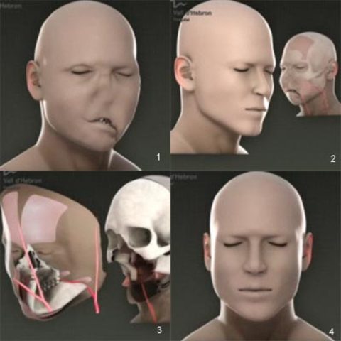 Trasplante total de cara