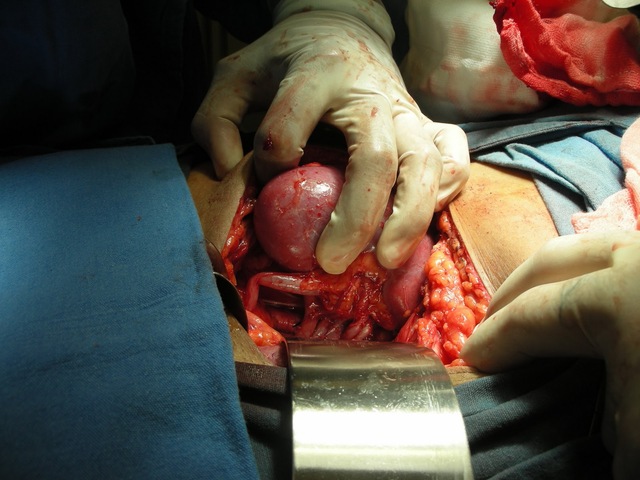 Trasplante de riñon