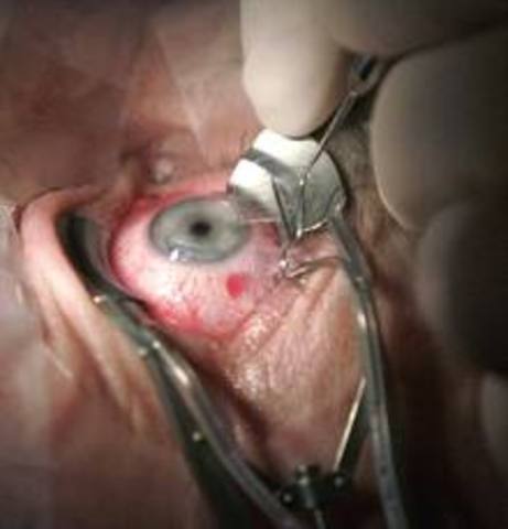 Trasplante de cornea