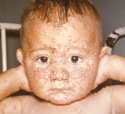 smallpox