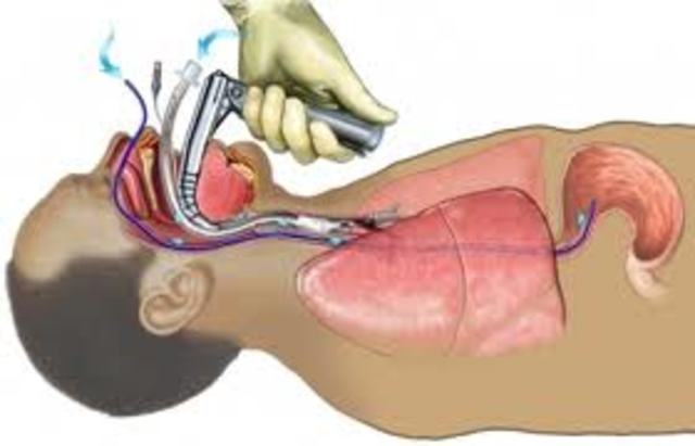 INTUBACION ENDOTRAQUIAL