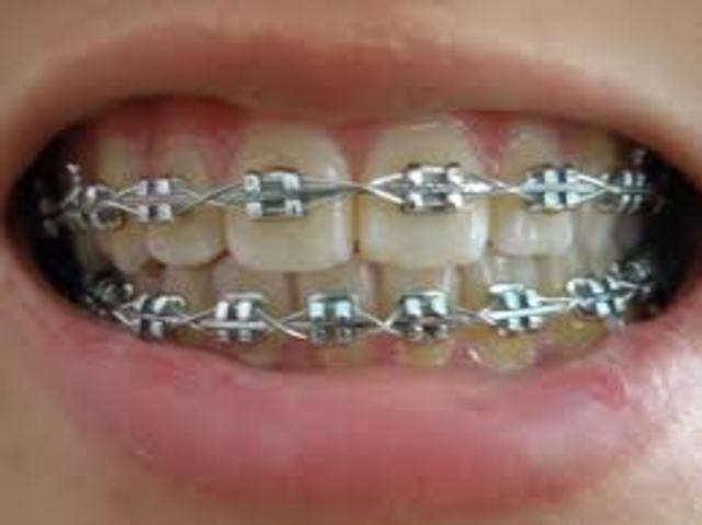 When I got my Braces