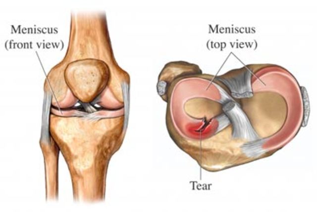 Knee Surgery