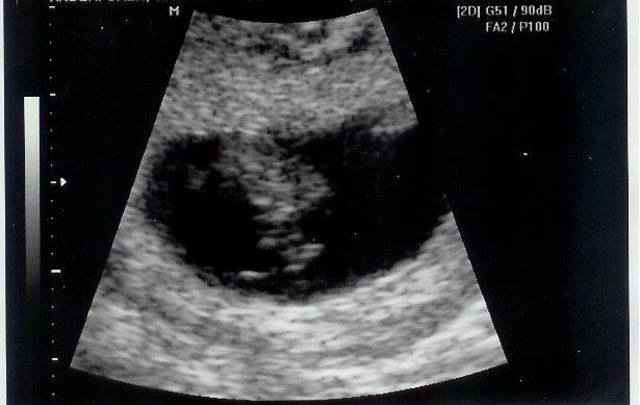 The Baby's First Heart Beat (5 weeks)