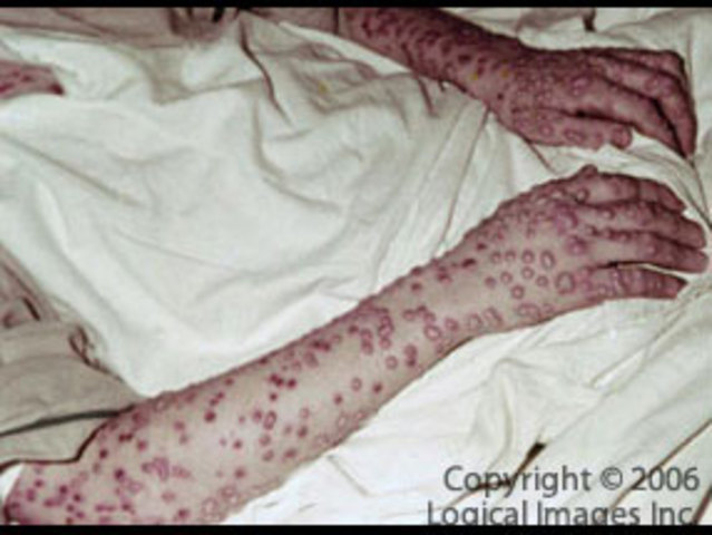 Smallpox creep up again