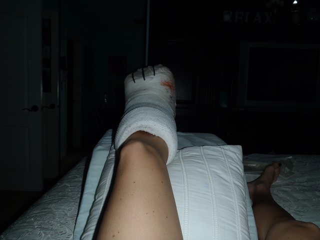 Reconstructive ankle surgery