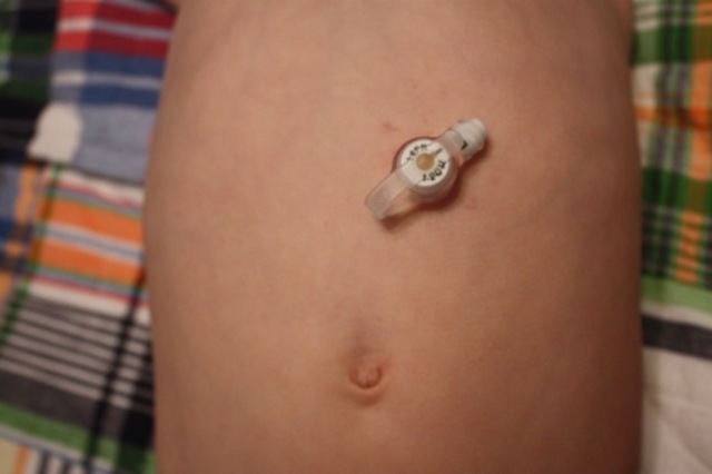 Gastrostomy tube inserted