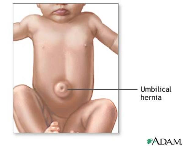 Umbilical hernia repair
