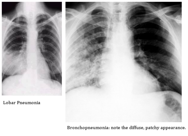 CF Related Bronchopneumonia