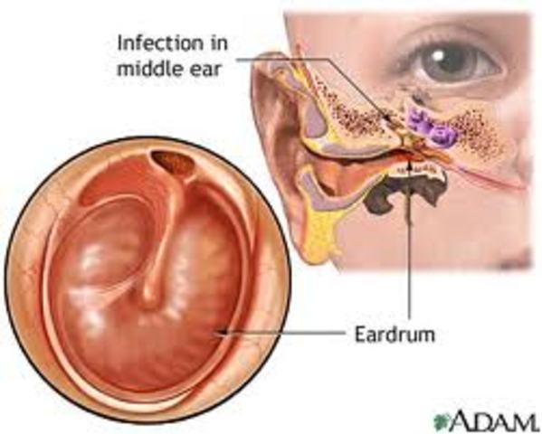Multiple Ear Infections