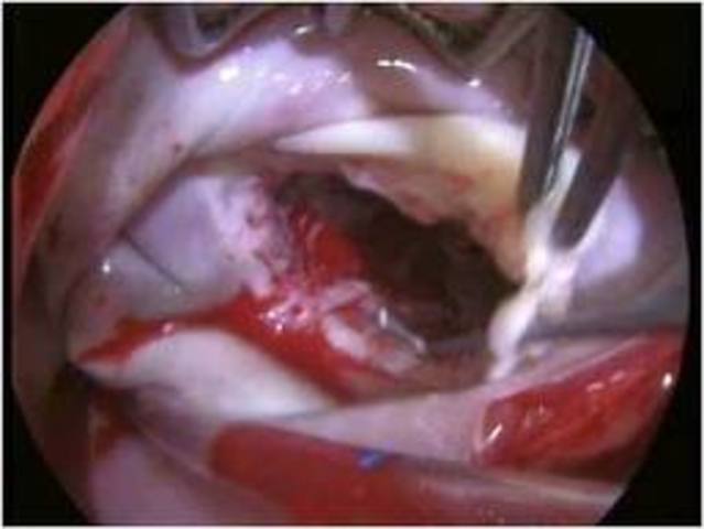 valvulas  del corazon