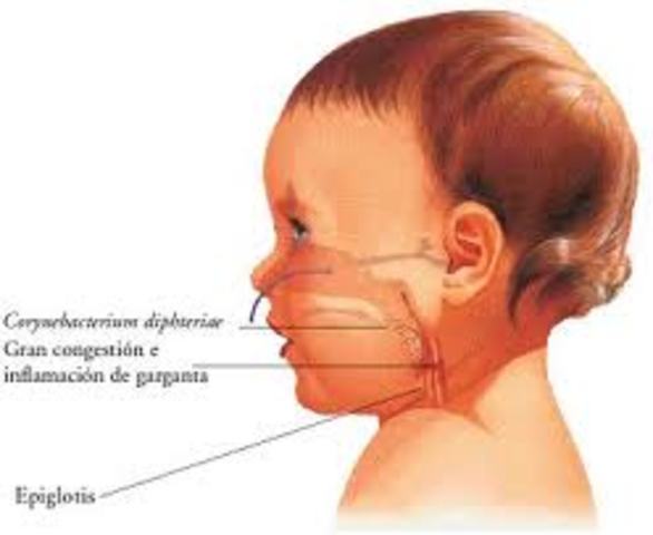Vacuna para la Difteria
