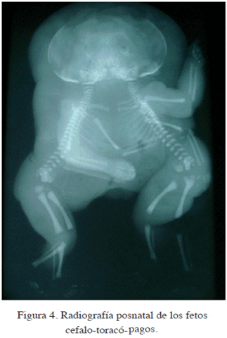 primera separacion de gemelos acoplados