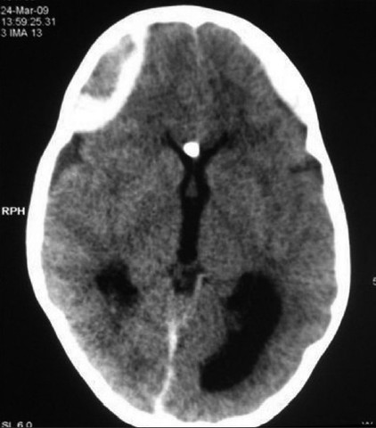 M.T. Recieves a Ventricular Reservoir