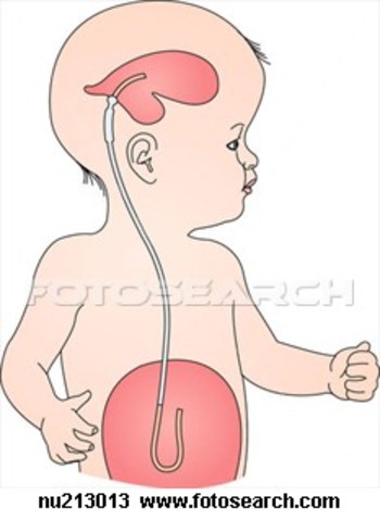 M.T. has 2nd Surgery