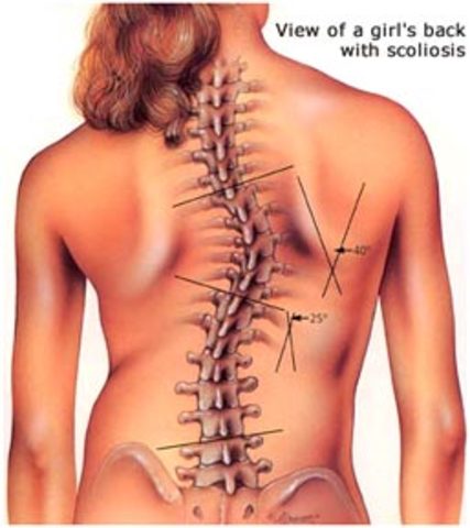 K.T. Scoliosis Correction