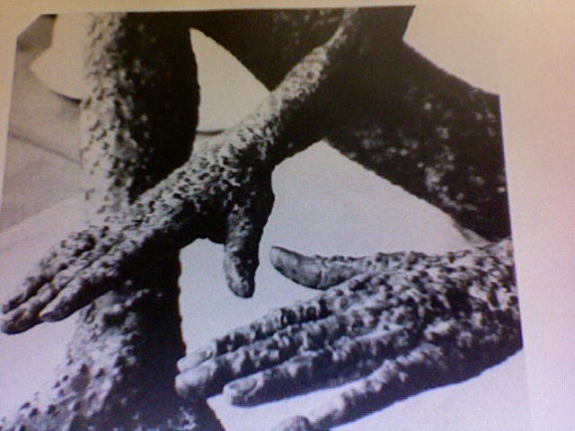 The smallpox epidemic returns!