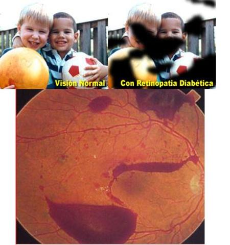diabeticos con con daños de los vasos del ojo