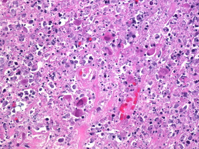 Lymphadenitis begins, patient