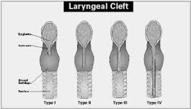 Laryngotracheal Reconstruction