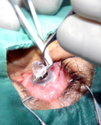 Primera cirugía de trasplante en seres humanos