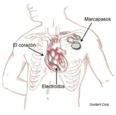 Marcapasos cardíacos
