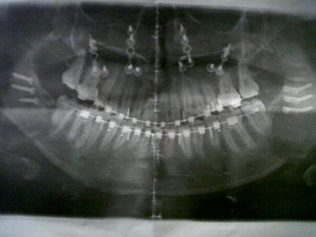 Jaw Surgery