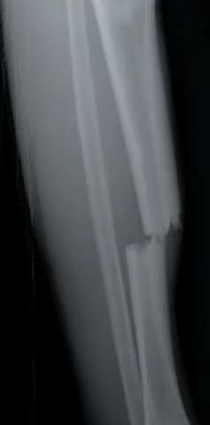 Broke my leg