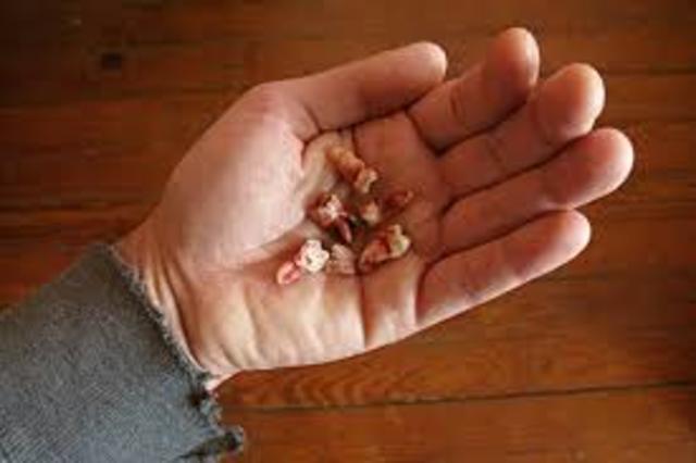 Removal of Wisdom Teeth