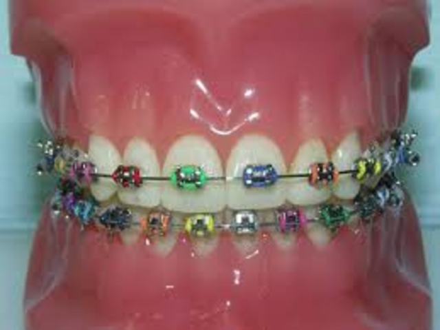 got braces