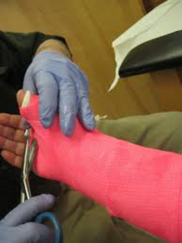 Cuando me rompí la muñeca