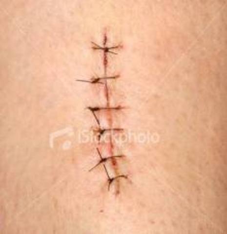 Sutures